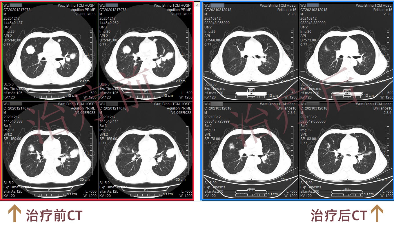 CT前后对比图.jpg CT前后对比图.jpg